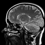 fMRI scan autism